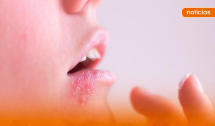 Estudo expõe hospitalizações e mortes causadas pela Herpes no Brasil