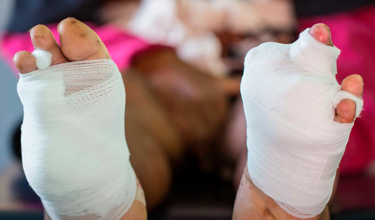 Diabetes: doença já figura como a principal causa de amputação não traumática, com 28 casos por dia