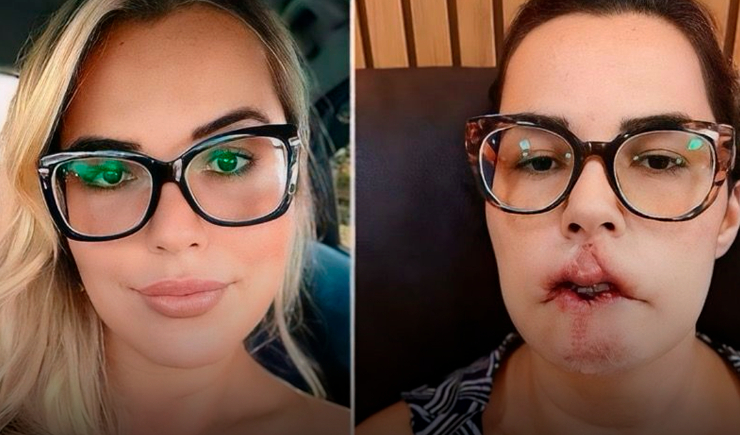Ácido hialurônico: cuidados ao realizar procedimentos com o preenchedor facial e corporal